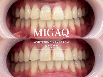 ミガク 京都四条大宮店(MIGAQ)/京都/四条大宮/ホワイトニング