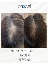 ユミト(Umit)/プロセルスカルプ