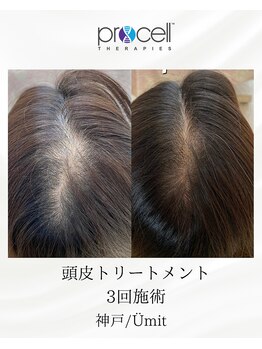ユミト(Umit)/プロセルスカルプ