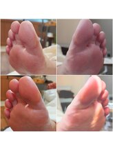 アンティ(Aunty)/指の腹のタコ、皮膚乾燥