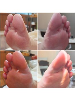 アンティ(Aunty)/指の腹のタコ、皮膚乾燥