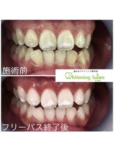 ホワイトニングサロン 札幌店/【ホワイトニング】#札幌#大通り