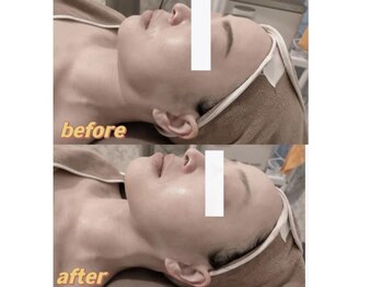 ミツレイ 九条店(MITUREI)/小顔デザイン