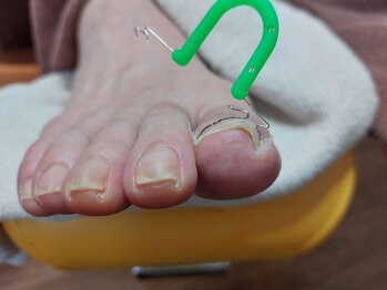 オルトグリップシュパンゲ