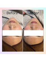 フレイヤビューティー スハダラボ 恵比寿(Freyia Beauty Suhada LABO)/-ポテンリフト-恵比寿