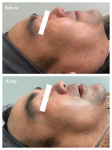 ピーロ(PiiiLO)/施術例/ソフト3回