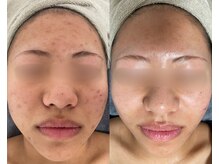 ノイ(noi.)の雰囲気（[ピーリング5回目の症例] 選べるハーブで剥離の有無も選べます！）