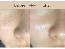 ソーヴ(SOLVE)/1回 Before→after/マツヤニWax