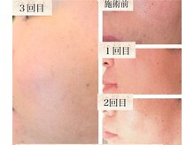 エクラ(Eclat)/VOS/フェイシャル/毛穴洗浄/美白