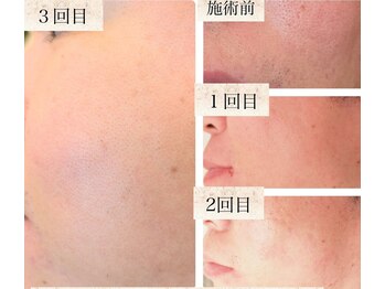 エクラ(Eclat)/VOS/フェイシャル/毛穴洗浄/美白