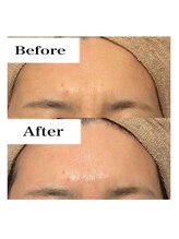 ライム 天神(LIME)/before&after おでこのしわ改善