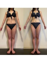 レナトゥス 銀座(Renatus)/BeforeAfter【美脚/東京/銀座】