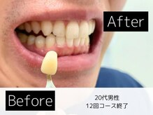ホワイトニングカフェ 葛西店(WhiteningCafe)/◎歯のホワイトニング施術写真◎