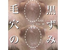 エステティック レイビス 八戸店(RAYVIS)/毛穴にオススメ◎