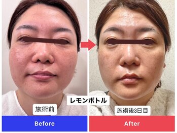 エトワール(etoile)/レモンボトル・小顔脂肪分解