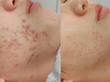 マリヴェリーテ(Mari verite)/大人ニキビ徹底改善