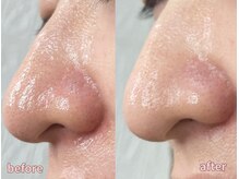 ミレット(Miretto)/【毛穴開き】水光ピーリング　