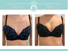 美人バスト 新潟店/ 【バストアップ★育乳】症例