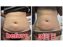 リラクゼーションサロン ラキ(laki)/サーモシェイプDEEP3回/痩身