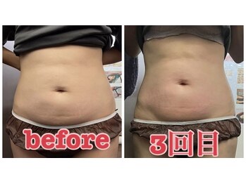 リラクゼーションサロン ラキ(laki)/サーモシェイプDEEP3回/痩身