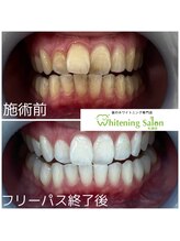 ホワイトニングサロン 札幌店/【ホワイトニング】#札幌#大通り