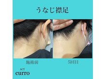 アクト クロ(ACT curro)/【うなじ襟足】脱毛施術例