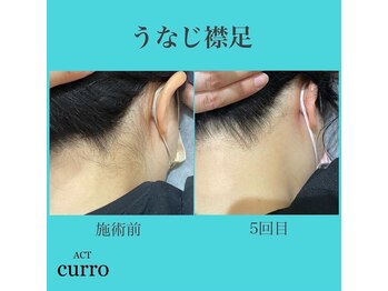 アクト クロ(ACT curro)/【うなじ襟足】脱毛施術例