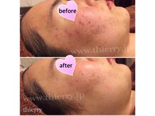 エステティックサロンティエリー/ハーブピーリング