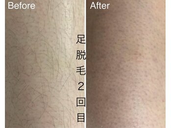 CDF 赤坂/足脱毛2回目初回4400