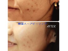 エタニティ 西宮店(Eternity)の雰囲気（最新韓国ハーブピーリングで肌質改善♪）