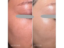 ハリ艶/毛穴/育毛促進◎無針なのに奥深くアプローチ! 銀座幹細胞