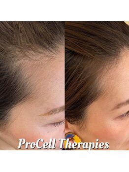 アイスブルー(Ice blue)/プロセルセラピーズBefore/After