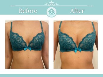 ラポッシュ(La poche)/バストアップ症例写真