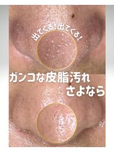 ウニカ(Unica)/アクアピール×高濃度導入1回