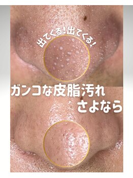 ウニカ(Unica)/アクアピール×高濃度導入1回