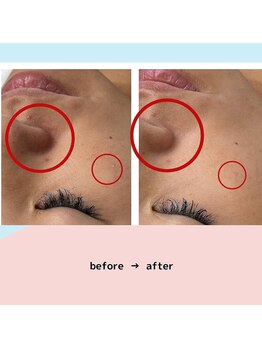 ロア ネイル アンド(loa nail and ...)/花粉、マスク荒れに