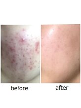 ザ フェース 京都御池店(THE FAITH)/お客様の肌変化