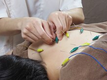 パルス鍼灸整骨院/背中の鍼×電気