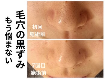 エリン(ERIN)/毛穴洗浄×ピーリング