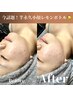 【小顔なりたい方必見！】今話題！瞬間小顔レモンボトル×光フェイシャル