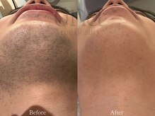 ウナ 西中島店(UNA)/濃い髭大歓迎！メンズ髭脱毛