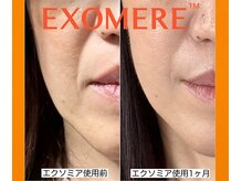 年齢肌に対応のエクソミア！シミ、シワ、ほうれい線、毛穴改善に