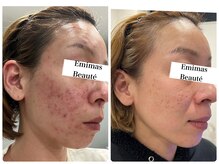 エステでもここまで変われる！自信が持てる素肌を叶えます！