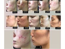 ウィズサロン 天神大名店(withサロン)/ハーブピーリング