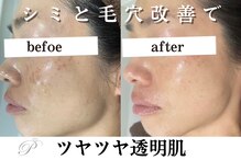 パールホワイトニング