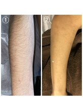 エイチ(H)/メンズ　腕