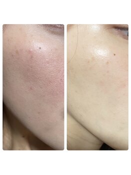 アイラッシュ ミル 御領店(eye lash Miru)/陶肌トリートメント~韓国女優肌