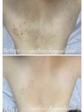 ミーラブ 鹿児島(miilove)/美背中ケア