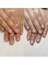 スマイルニコ(smile nico)/深爪矯正　自爪育成