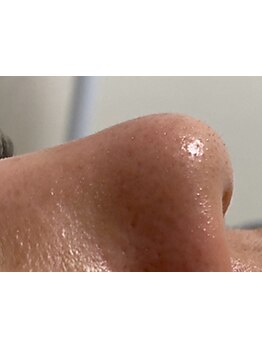 毛穴ケアをしたい